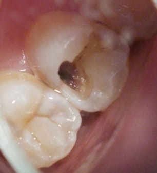 激痛 虫歯 治療 後 治療前は痛くなかった歯が、治療後に痛くなりました