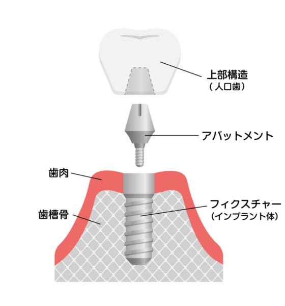 インプラント治療 Dental Implantation あきる野市の年中無休の歯医者 きらら歯科