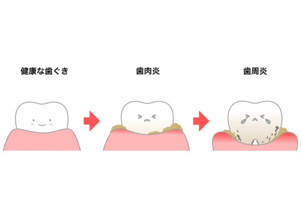 健康な歯茎について