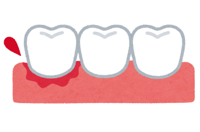 歯周病歯茎からの出血