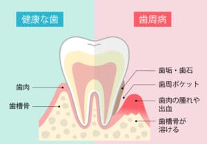 歯周病 歯周病治療