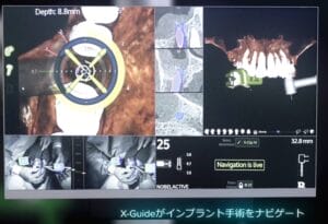 Xガイド インプラント インプラント手術