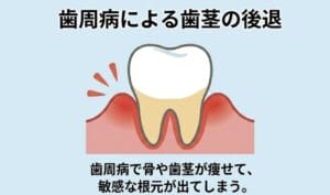 歯周病 歯肉退縮