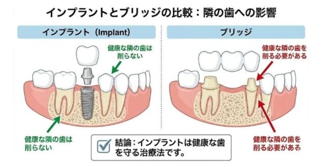インプラント　ブリッジ　