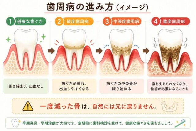 歯周病の進み方