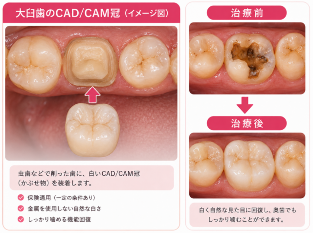 CADCAM大臼歯