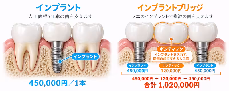 インプラントとインプラントブリッジ