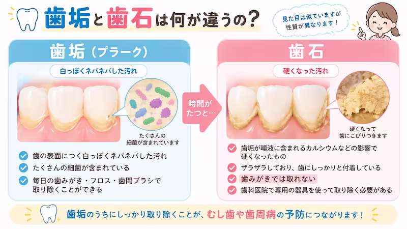 歯垢と歯石
